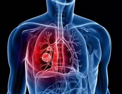 肺癌的“五早”预防你了解吗？ 这是我听过最好的解答